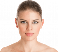 White Woman skin retouch before and after